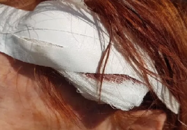 A través de las redes sociales se mostró la herida sufrida en la cabeza por la adulta mayor, y por la cual requirió de suturas en el hospital Nicolás A. Solano, además de otros exámenes médicos.