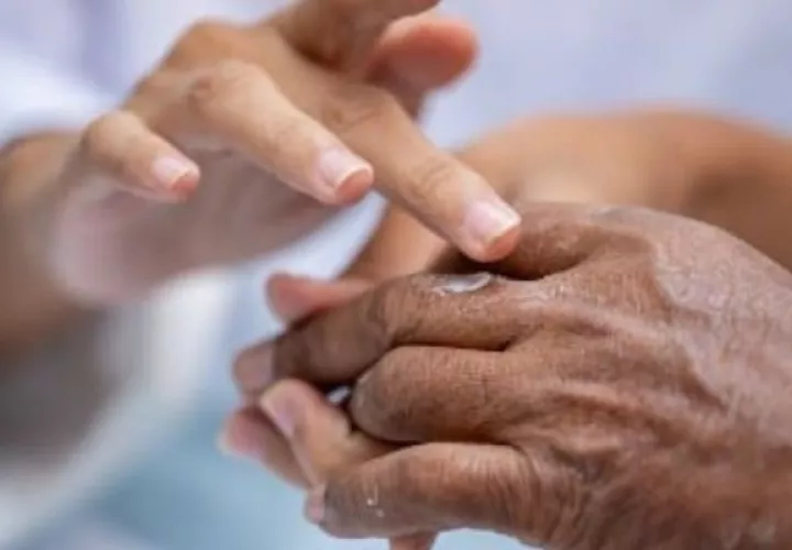 La lepra es una enfermedad infecciosa crónica que es curable y no contagiosa. Foto: Cortesía