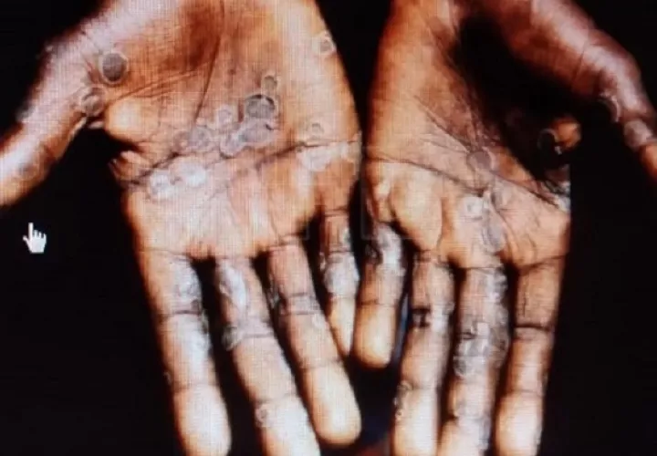 La viruela símica causa lesiones cutáneas en manos, plantas de los pies o cara. Foto: Archivo Ilustrativa 