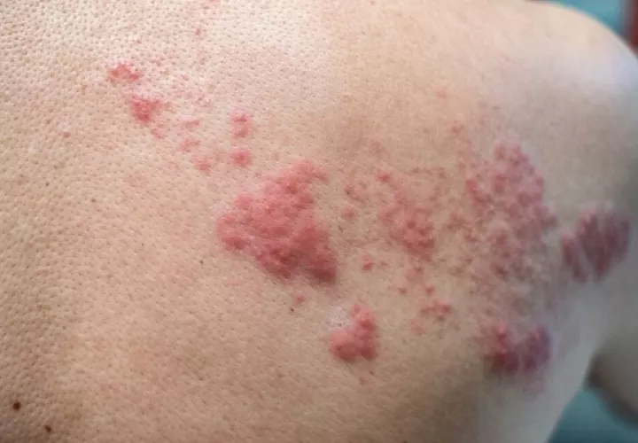 La neuralgia post-herpética es la patología desencadenante más frecuente del herpes zóster. 