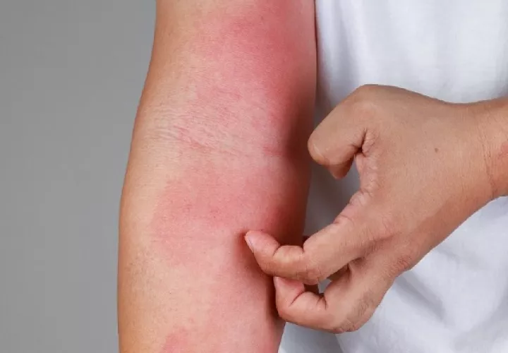 La dermatitis atópica afecta al menos a 230 millones de personas en todo el mundo. Foto: Pexels