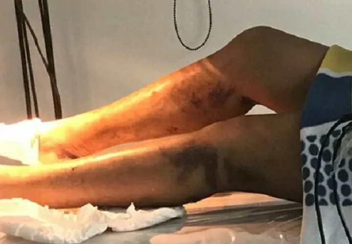 Los biopolímeros causan serios problemas a la salud. Foto: Cortesía