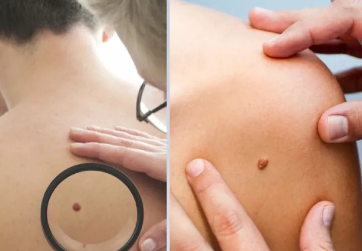 Un lunar inusual podría ser señal de melanoma. Foto: Pexels