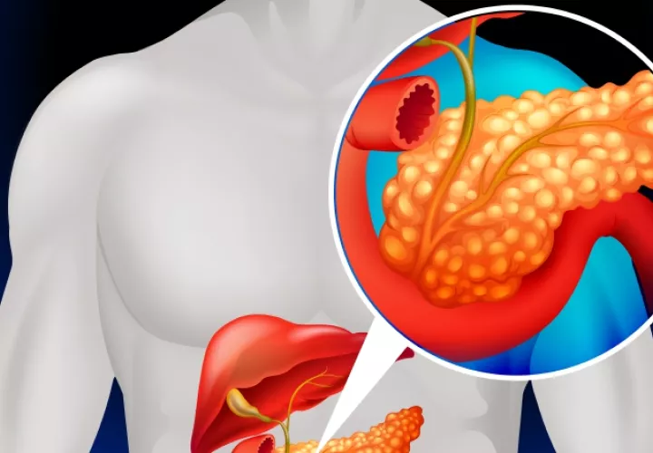 Las personas con obesidad y diabetes tipo 2 tienen más riesgo de padecer cáncer de páncreas.  Ilustrativa / Freepik