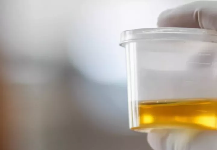 Algunos alimentos y medicamentos pueden cambiar el color de la orina. Foto: Pexels