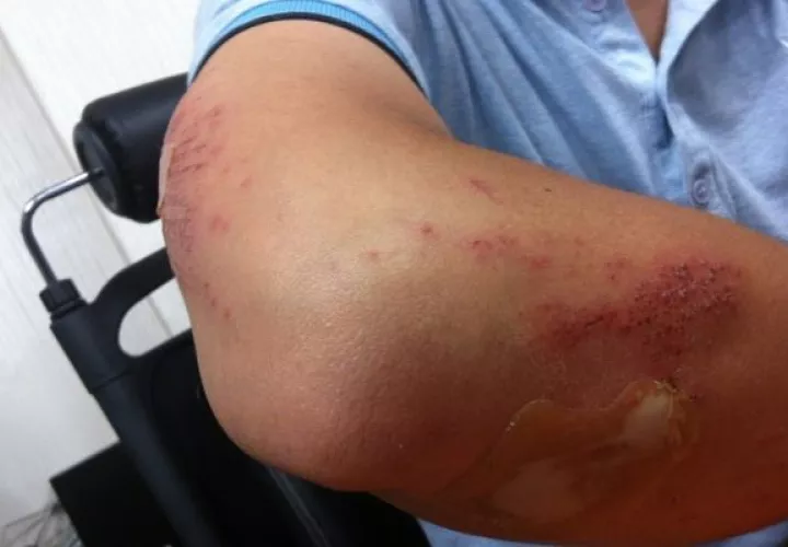 En Panamá, la cifra es de aproximadamente  318 las personas que viven con este trastorno genético, de las cuales 281 son de hemofilia A y 37 de hemofilia B. Foto: Archivo