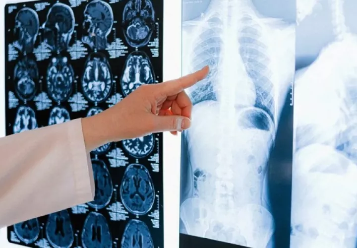Los síntomas del cáncer de pulmón no son muy llamativos, pero hay situaciones que no son normales. Foto: EFE