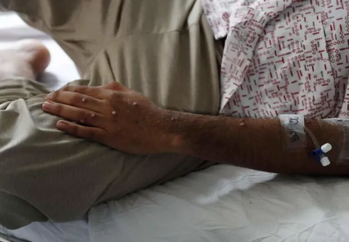 Un  paciente es atendido tras ser diagnosticado con mpox. Foto: EFE