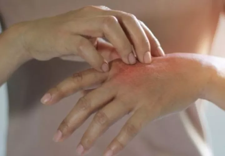 En 2024 Panamá fue reconocida por la International Federation of Associations, por haber liderado el esfuerzo para posicional la psoriasis en la agenda global. Foto. Ilustrativa