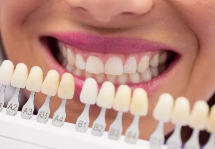 Las carillas dentales 'Natural 3D' ofrecen un aspecto más natural y estético. Foto: Ilustrativa / Freepik