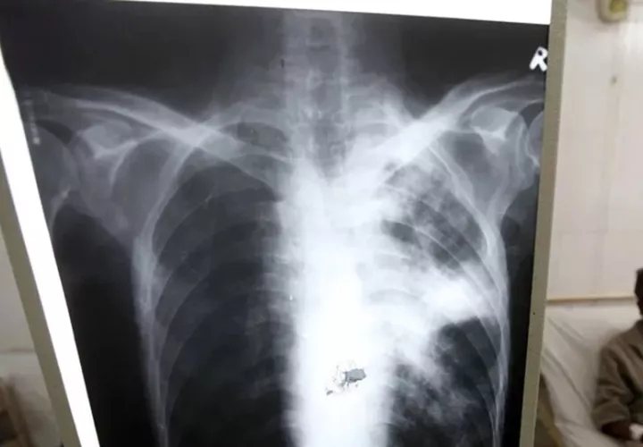 La tuberculosis  puede ser mortal si no se trata. Foto: EFE