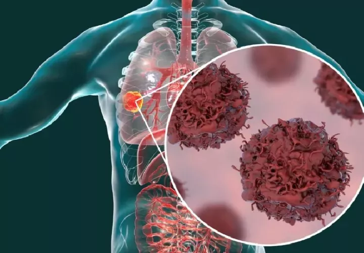 El tabaquismo es responsable de entre el 80 y 90% de los casos de cáncer de pulmón en el país.