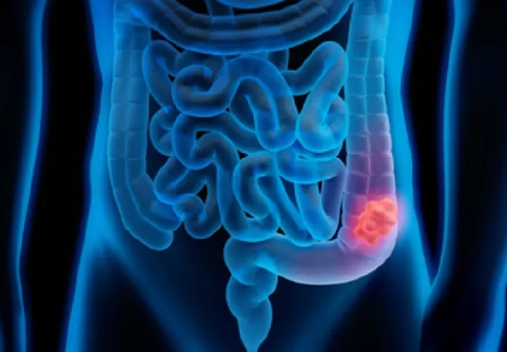 La sobrevivencia es más cuando el cáncer es diagnosticado en una etapa temprana. Cortesía