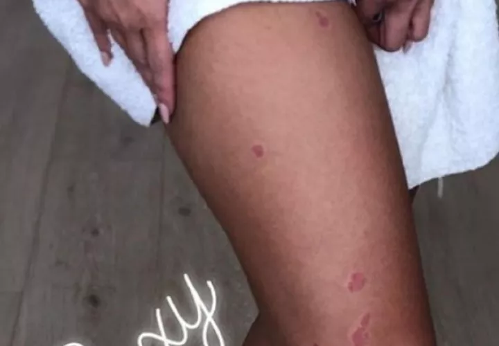Kim Kardashian muestra sus lesiones de la psoriasis. Foto: Instagram