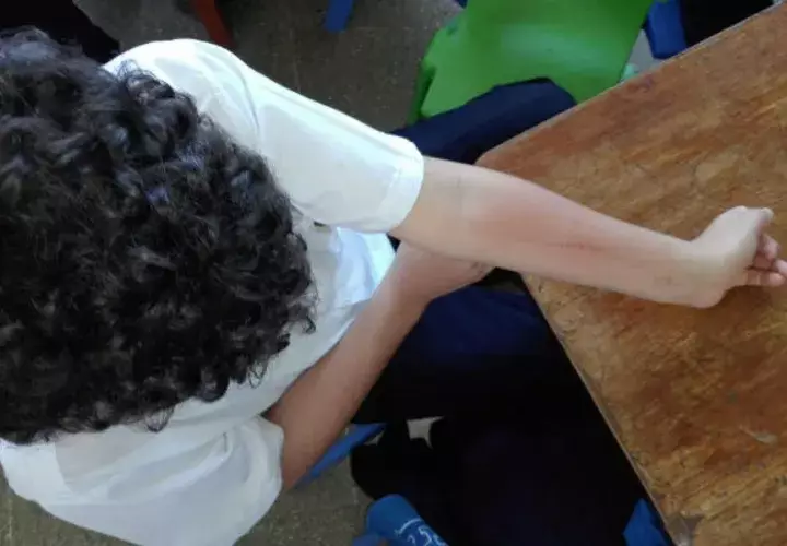 Los estudiantes del centro educativo en La Chorrera, en Panamá Oeste, presentan reacciones alérgicas en la piel. 