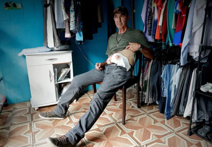  Isaque Ferreira da Silva, de 64 años fue operado de urgencia en un hospital público en el 2017, carga desde hace un año y dos meses la bolsa de colostomía. FOTO/EFE