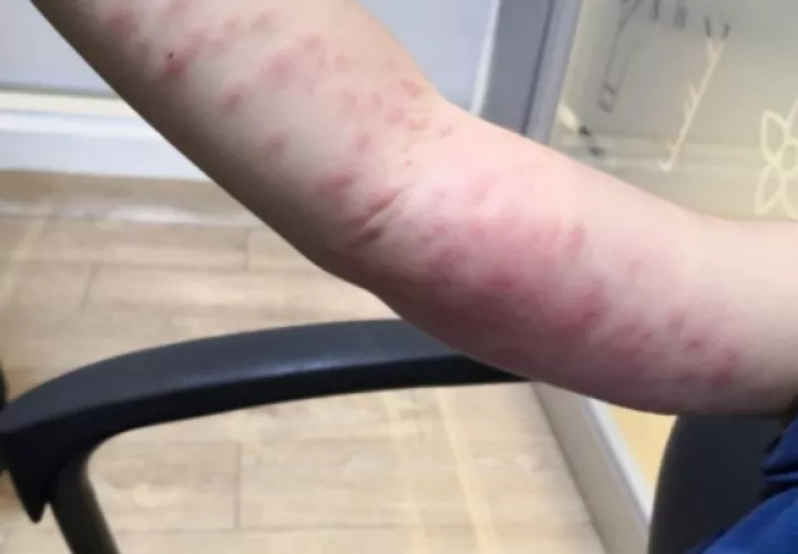 No tenemos casos reportados de “ lepidopterismo”, solo algunas alergias propias de la temporada que han afectado a algunos ciudadanos, dijo la directora de Salud en Chiriquí Gladys Novoa. Foto/Mayra Madrid