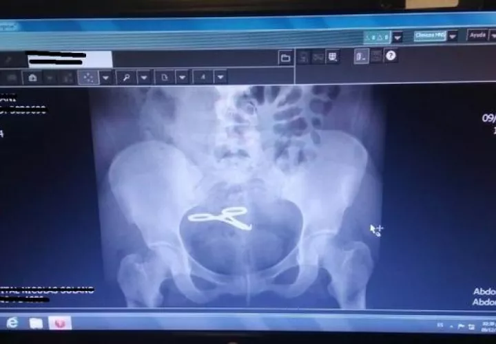 Tras la mala praxis la mujer sufrió una trombosis venosa profunda que casi termina con un paro cardiorespiratorio. Foto: redes sociales.