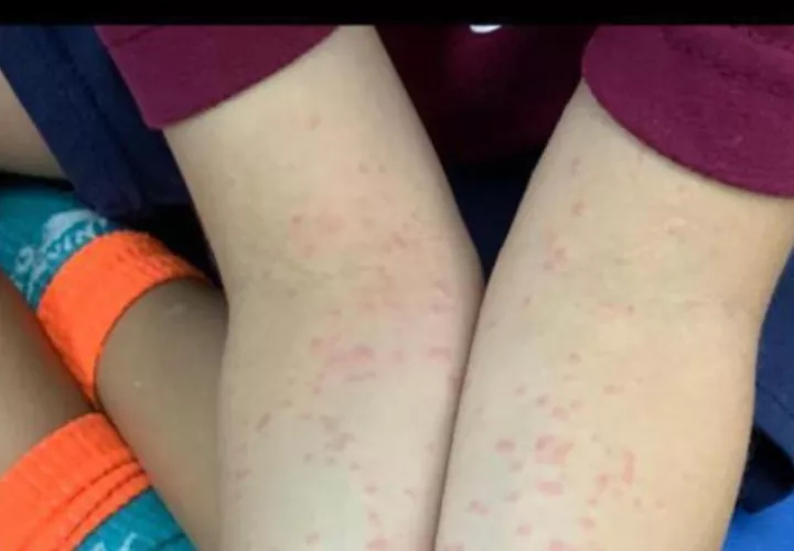 Un vistazo de cómo serían las lesiones causadas por la polilla y que debe ser tratada por un médico. Foto de cortesía
