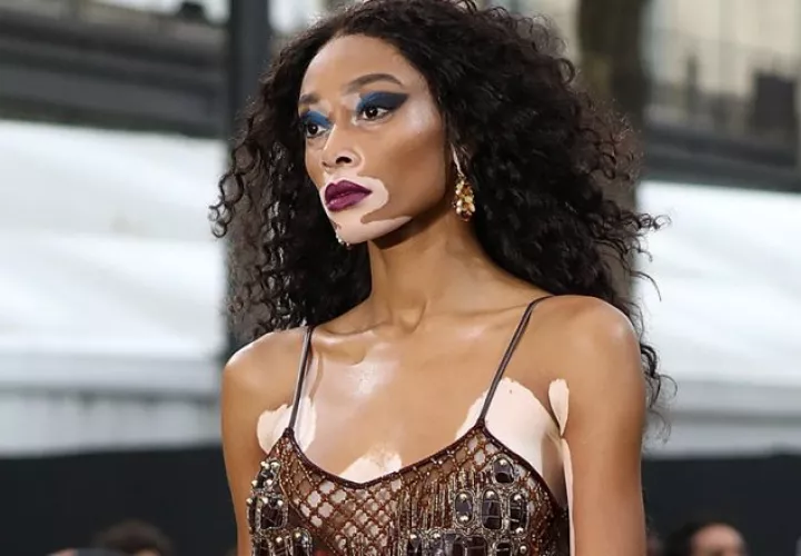 Winnie Harlow.